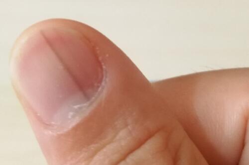 指甲上有豎紋是怎么回事？指甲上有黑線及手指甲上有豎紋怎么辦？