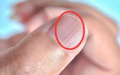 指甲上有豎紋是怎么回事？指甲上有黑線